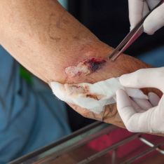 ABORDAJE DE HERÍDAS CRÓNICAS (TARDES)